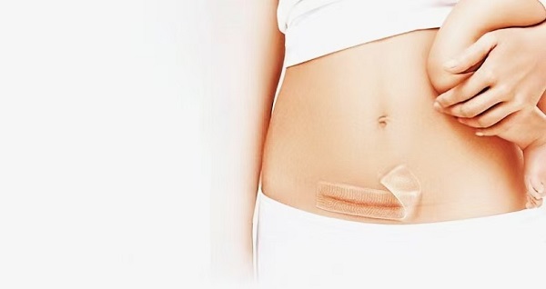 Napa Lembaran Scar Gel Silikon Kandel Dadi Populer?