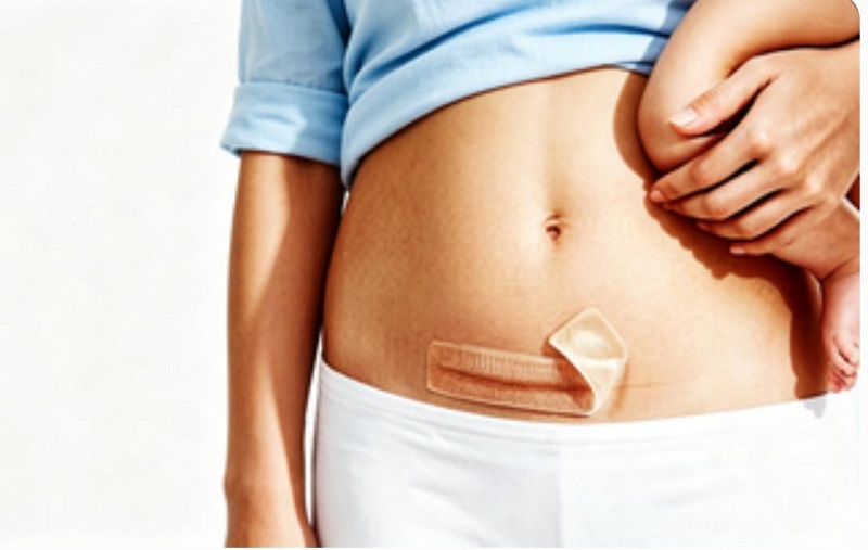 Patch Scar Silicone CmallBio Bebas Hormon kanggo Perawatan Parut Caesarean