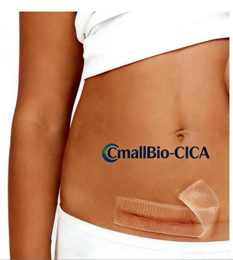 Patch Scar Apa sing Paling Apik kanggo Scars Hypertrophic C-Section? A 2026 Pandhuan Tuku Tambalan Bekas Luka Kelas Medis